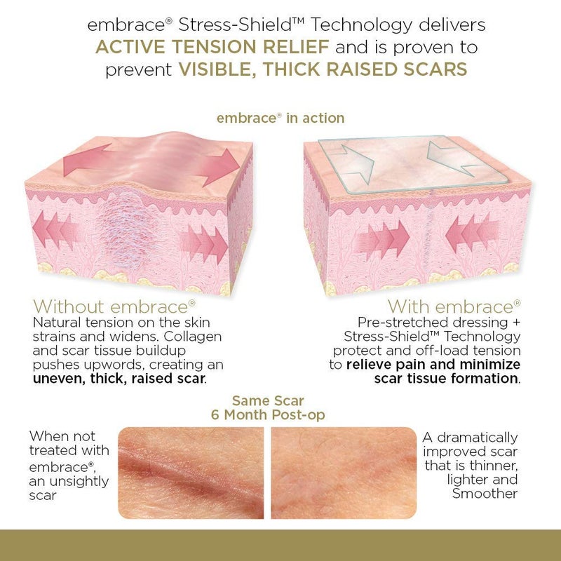 Embrace Active Scar Defense for New Scars, FDA-Cleared Medical-Grade Silicone Scar Sheets for Hypertrophic & Keloid Scar Treatment, 6.3 Inch, Extra-Large, 30-Day Supply - Image 3